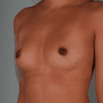 Breast Augmentation Before & After Patient #359