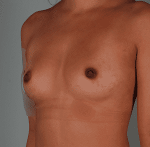Breast Augmentation Before & After Patient #359