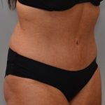 Abdominoplasty Before & After Patient #1443