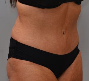 Abdominoplasty Before & After Patient #1443