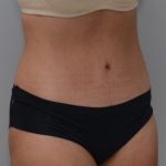 Abdominoplasty Before & After Patient #1442