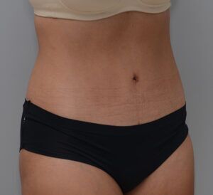 Abdominoplasty Before & After Patient #1442