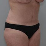 Abdominoplasty Before & After Patient #1444