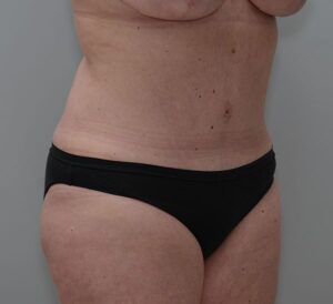 Abdominoplasty Before & After Patient #1444