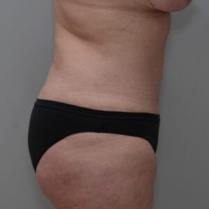 Bodytite Before & After Patient #1556