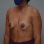 Breast Augmentation Before & After Patient #249