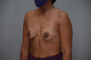 Breast Augmentation Before & After Patient #249