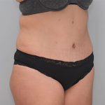 Abdominoplasty Before & After Patient #1273