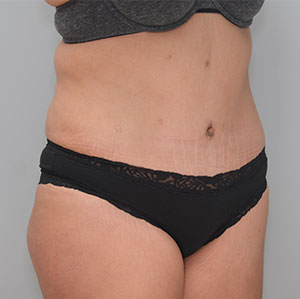 Abdominoplasty Before & After Patient #1273