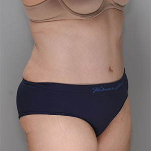 Abdominoplasty Before & After Patient #1383