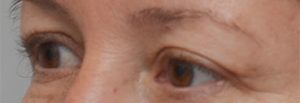 Blepharoplasty Before & After Patient #1701