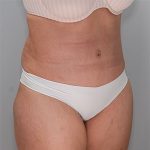 Abdominoplasty Before & After Patient #1329