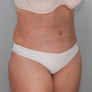 Abdominoplasty Before & After Patient #1329