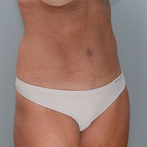 Abdominoplasty Before & After Patient #1328