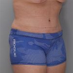 Abdominoplasty Before & After Patient #1272