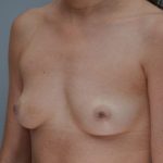 Breast Augmentation Before & After Patient #250