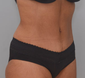 Abdominoplasty Before & After Patient #1386