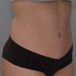 Abdominoplasty Before & After Patient #1385