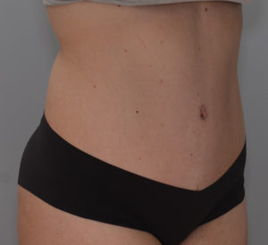 Abdominoplasty Before & After Patient #1385