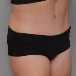 Abdominoplasty Before & After Patient #1211