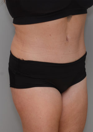 Abdominoplasty Before & After Patient #1211