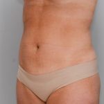 Liposuction with Bodytite Before & After Patient #1557
