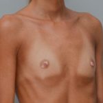 Breast Augmentation Before & After Patient #411