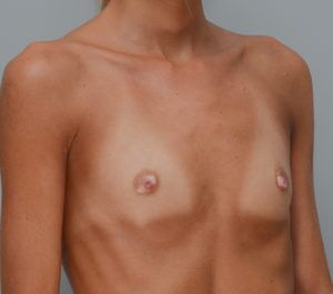 Breast Augmentation Before & After Patient #411