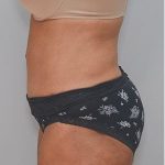 Abdominoplasty Before & After Patient #1207