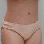 Abdominoplasty Before & After Patient #1208