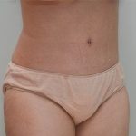 Liposuction Before & After Patient #1587