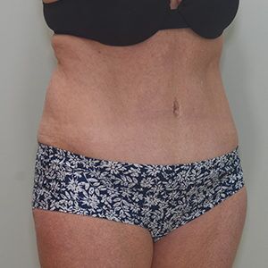 Abdominoplasty Before & After Patient #1209