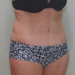 Abdominoplasty Before & After Patient #1588