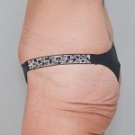 Abdominoplasty Before & After Patient #1327