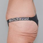 Abdominoplasty Before & After Patient #1327
