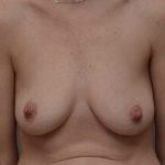 Breast Augmentation Before & After Patient #468