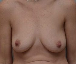 Breast Augmentation Before & After Patient #468