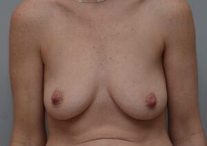 Breast Augmentation Before & After Patient #468