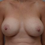 Breast Augmentation Before & After Patient #468