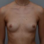 Breast Augmentation Before & After Patient #467