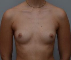 Breast Augmentation Before & After Patient #467