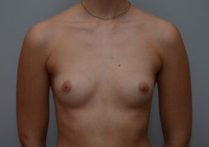 Breast Augmentation Before & After Patient #467
