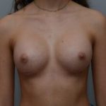 Breast Augmentation Before & After Patient #467