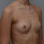 Breast Augmentation Before & After Patient #467