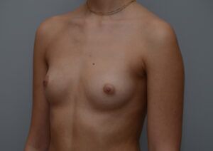 Breast Augmentation Before & After Patient #467