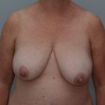 Breast Lift Before & After Patient #1034