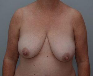 Breast Lift Before & After Patient #1034