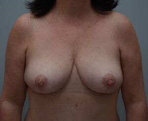 Breast Lift Before & After Patient #1034