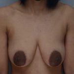 Breast Lift Before & After Patient #1035