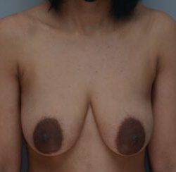 Breast Lift Before & After Patient #1035